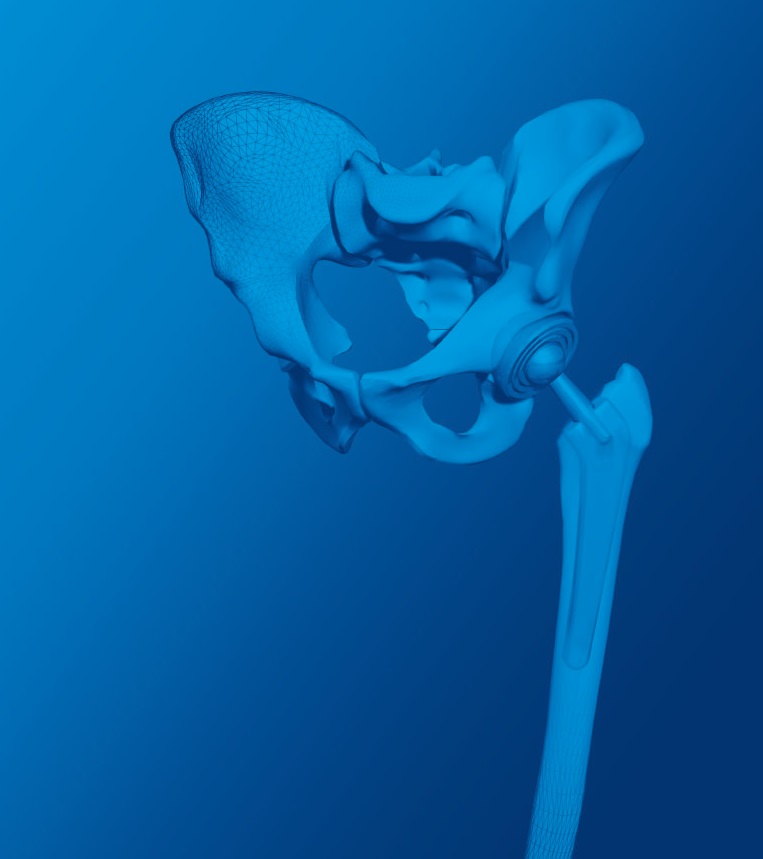 Orthopedic and Dental Implants, Ansys, Simulia, Siemens, Integrated FEA|CFD with Artificial Intelligence