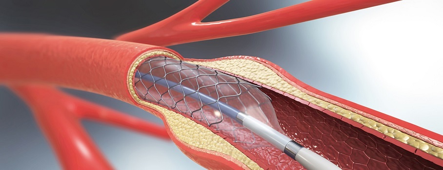 Cardiovascular Implants, Ansys, Simulia, Siemens, Integrated FEA|CFD with Artificial Intelligence